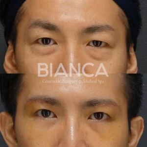 眉下切開＋上瞼脂肪取り・目の下クマたるみ取り