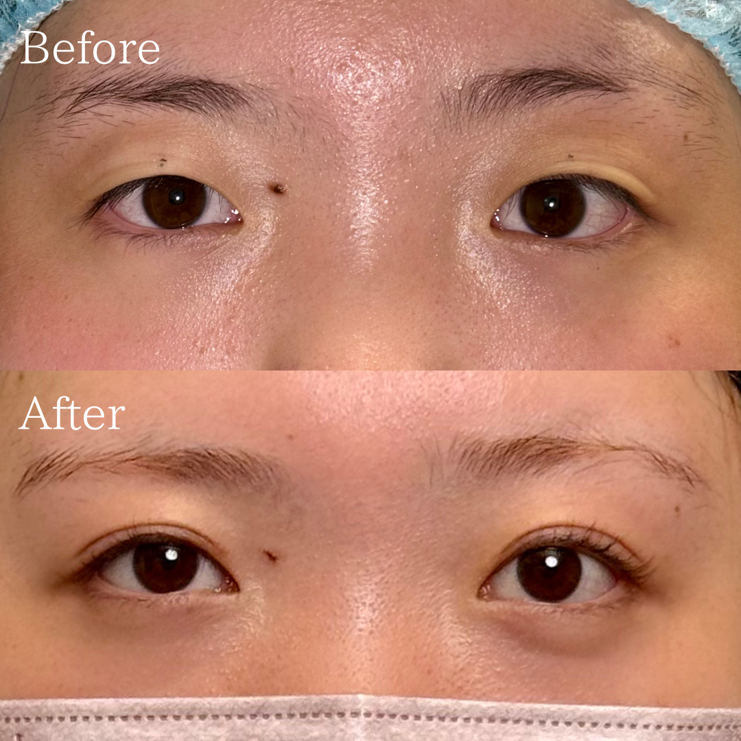 二重切開法 ・目頭切開