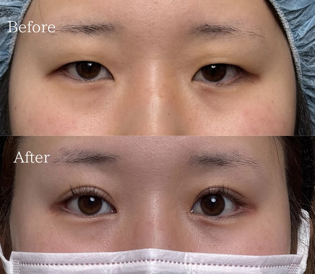 眼瞼下垂切開法 ・目頭切開 ・タレ目尻切開