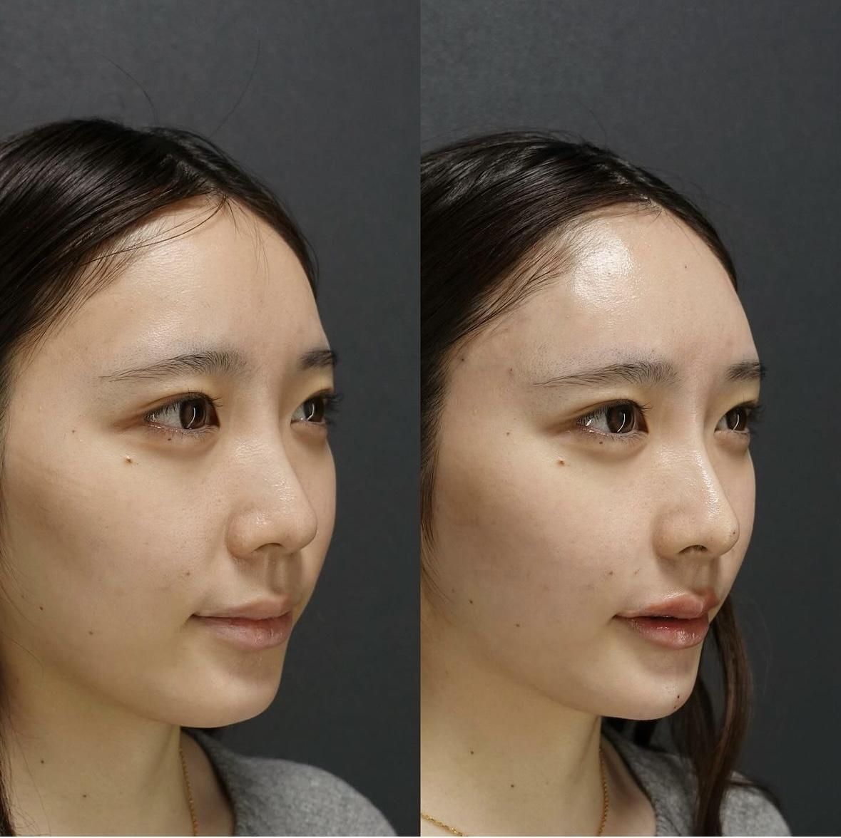 ヒアルロン酸注射