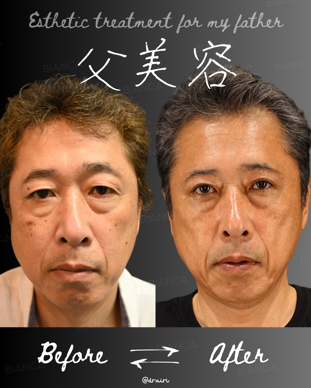 眉下切開・ピコスポット