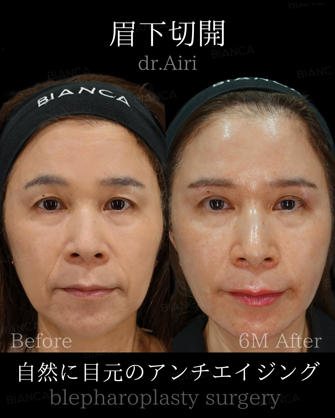 眉下切開・ヒアルロン酸注射