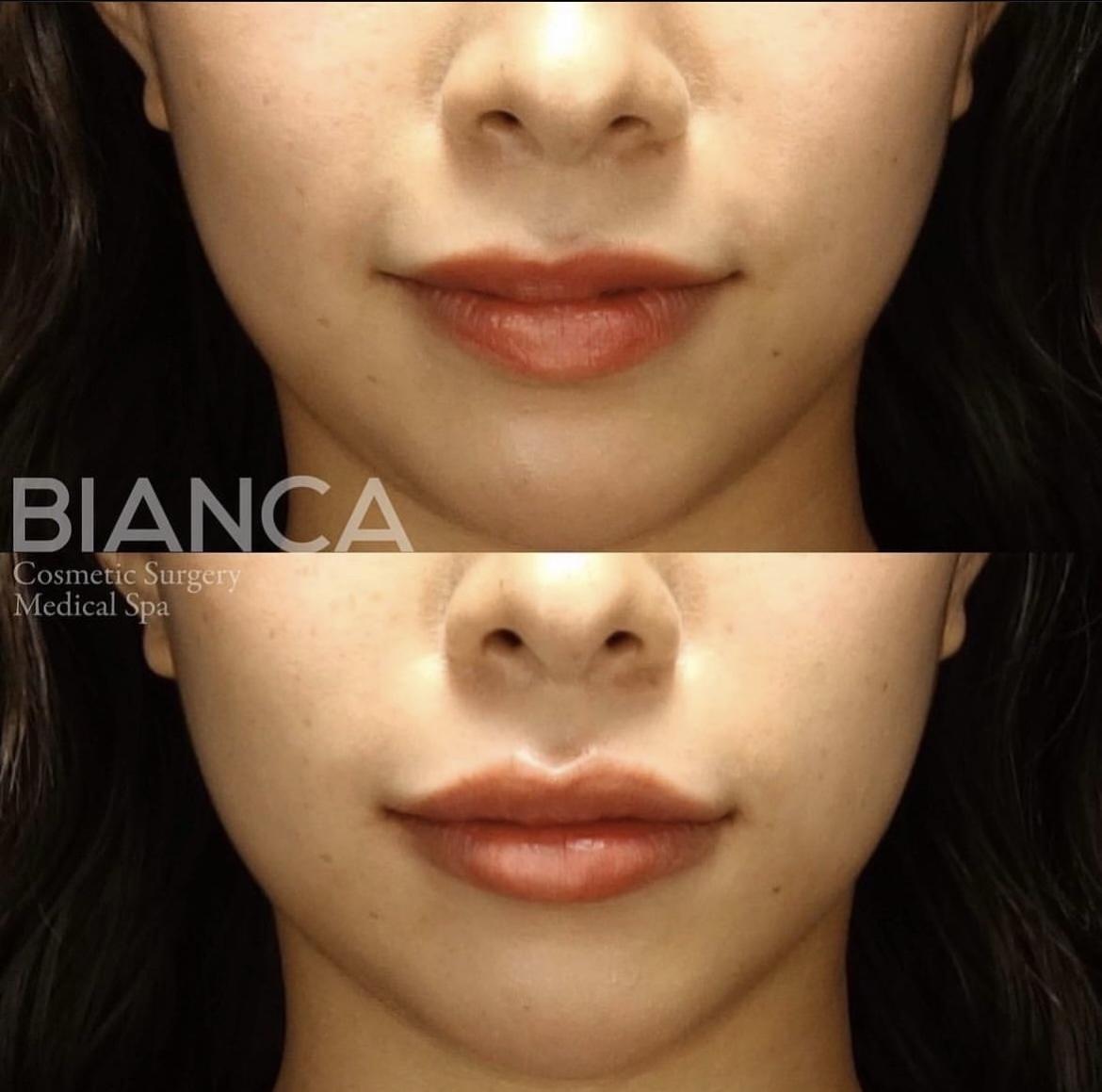 ヒアルロン酸注射