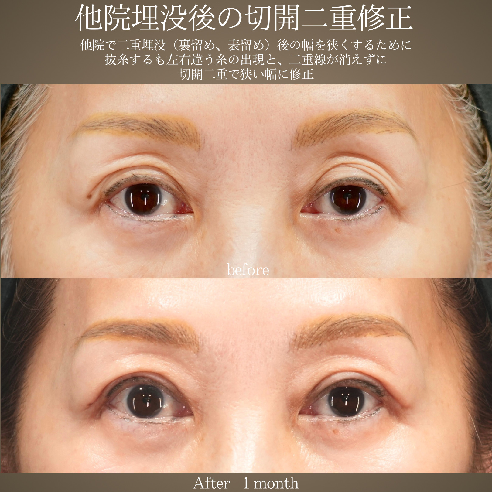 他院埋没後の修正 （埋没糸の抜糸・眼瞼下垂切開法）