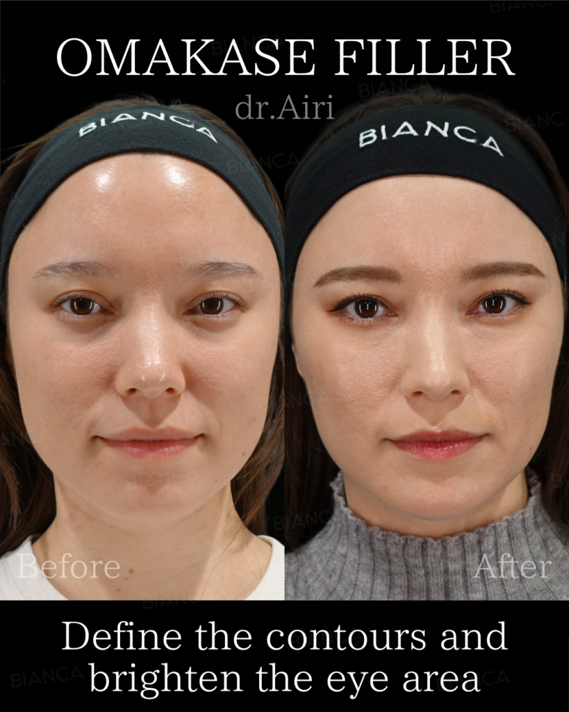 ボトックス注射・ベビーコラーゲン