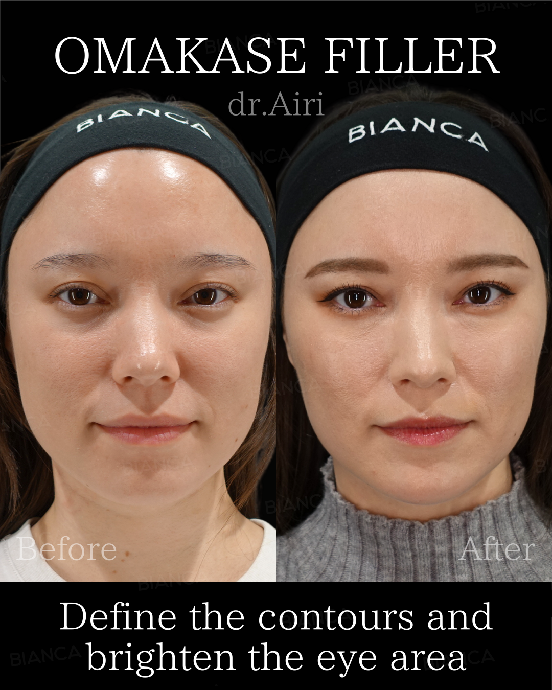 ボトックス注射・ベビーコラーゲン