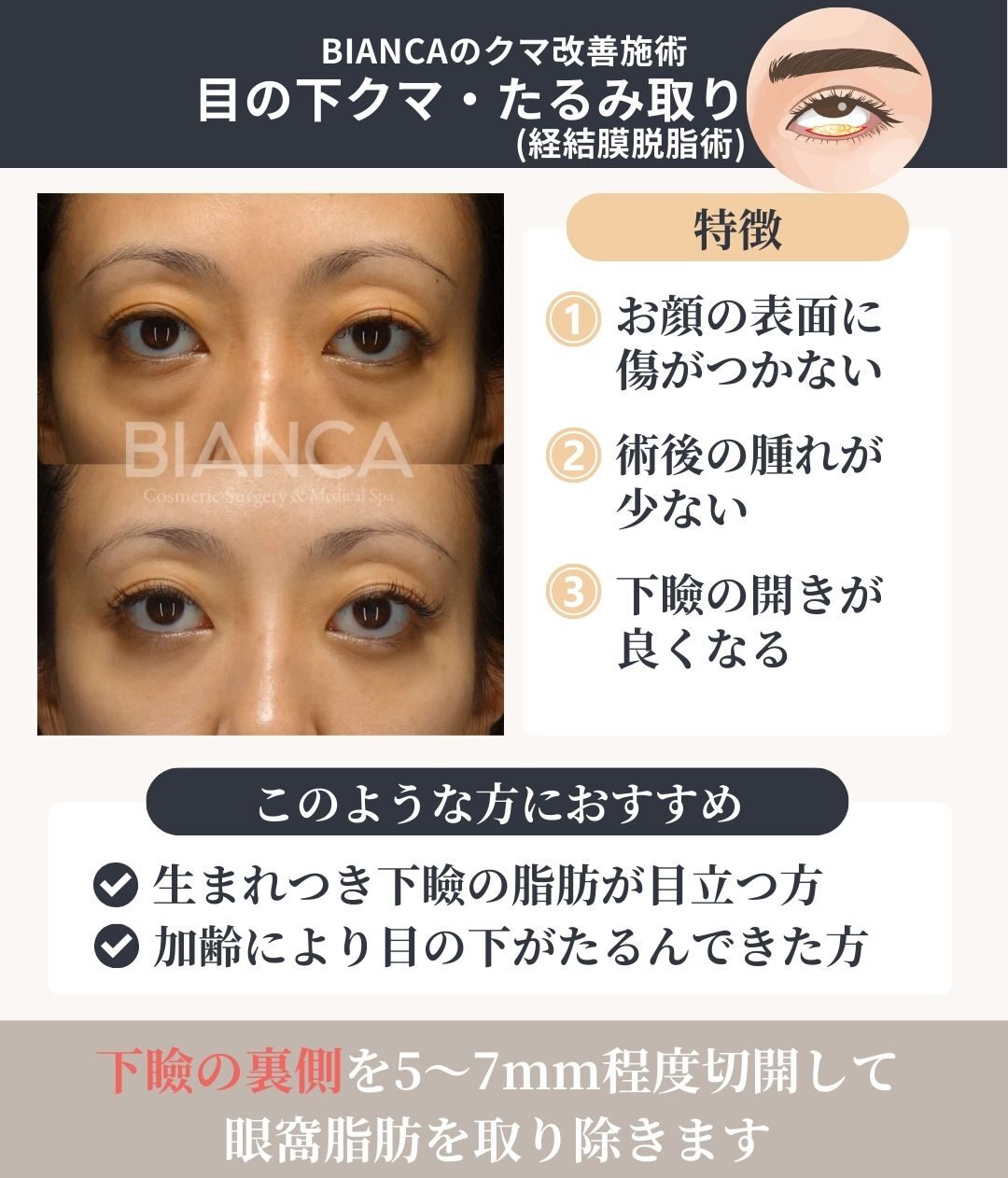 ハムラ法と脱脂の違いは？どのような方におすすめか