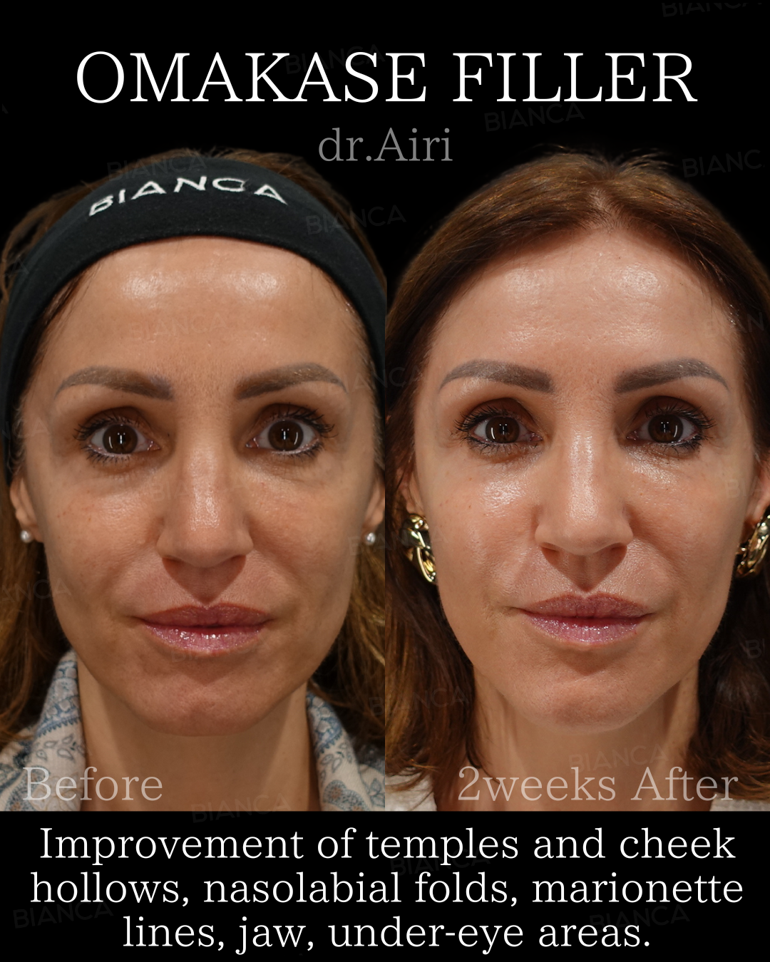 ヒアルロン酸注射・ベビーコラーゲン