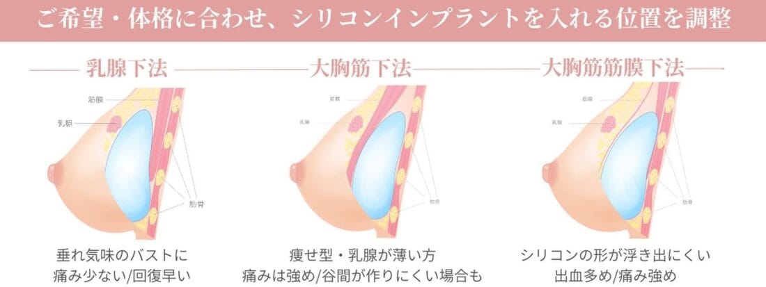 シリコンバッグ豊胸 銀座・表参道にあるBIANCA CLINIC ビアンカクリニック｜美容外科・美容皮膚科・再生医療・美容婦人科・美容内科・医療アートメイク