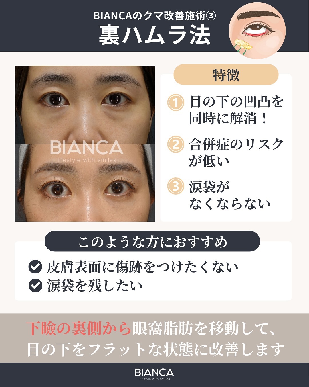 裏ハムラ法とは