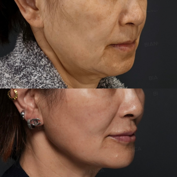 脂肪吸引(頬・顎下）エンブレイスRF頬+顎下（フェイスタイト・モフィウス８）BIANCALIFT 6本、ヒアルロン酸(鼻・唇・顎）｜銀座・表参道にあるBIANCA CLINIC ビアンカクリニック｜美容外科・美容皮膚科・再生医療・美容婦人科・美容内科・医療アートメイク