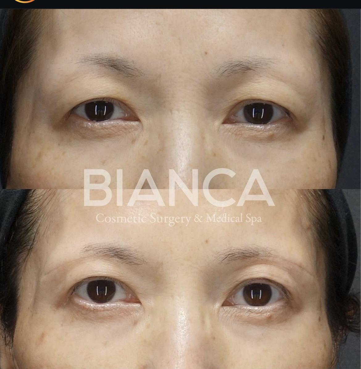 眉下切開＋ROOF切除・上眼窩脂肪除去