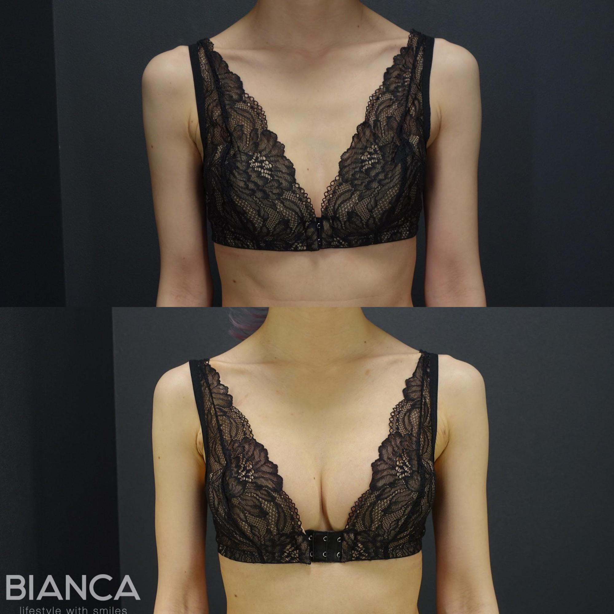 ハイブリッド豊胸（シリコンインプラント＋CRF）