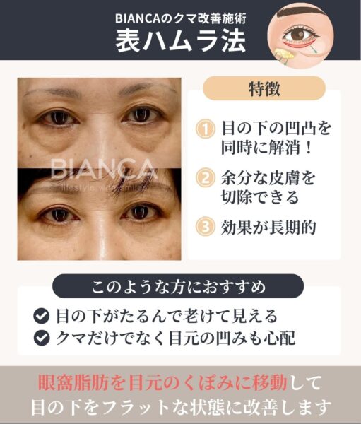 ハムラ法 銀座・表参道にあるBIANCA CLINIC ビアンカクリニック｜美容外科・美容皮膚科・再生医療・美容婦人科・美容内科・医療アートメイク