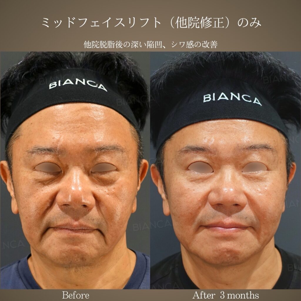 ミッドフェイスリフト