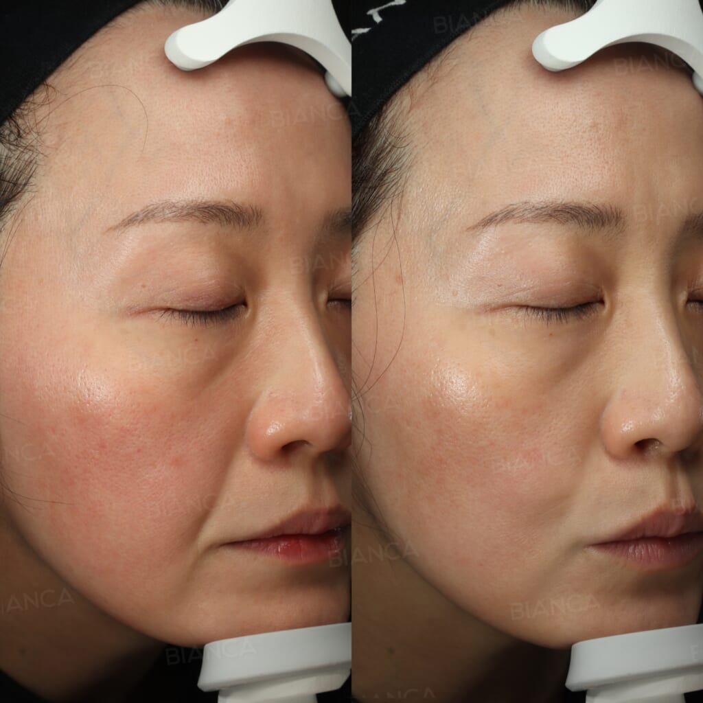 美肌カスタマイズ治療