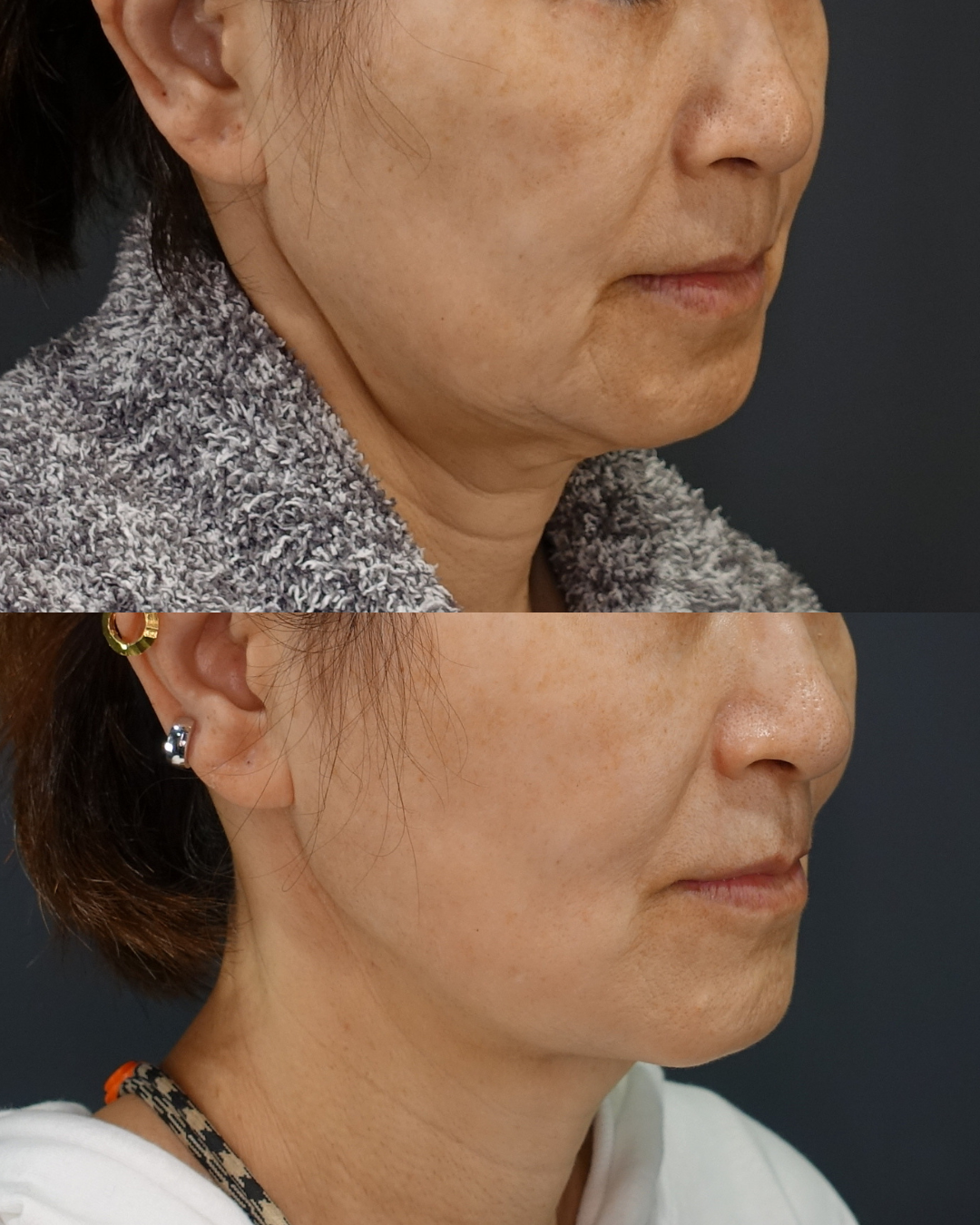 脂肪吸引・フェイスタイト