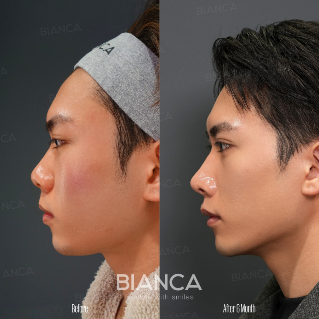 眉間・隆鼻オーダーメイドプロテーゼ・鼻中隔延長・鼻翼縮小+α法・貴族手術・顎ヒアルロン酸