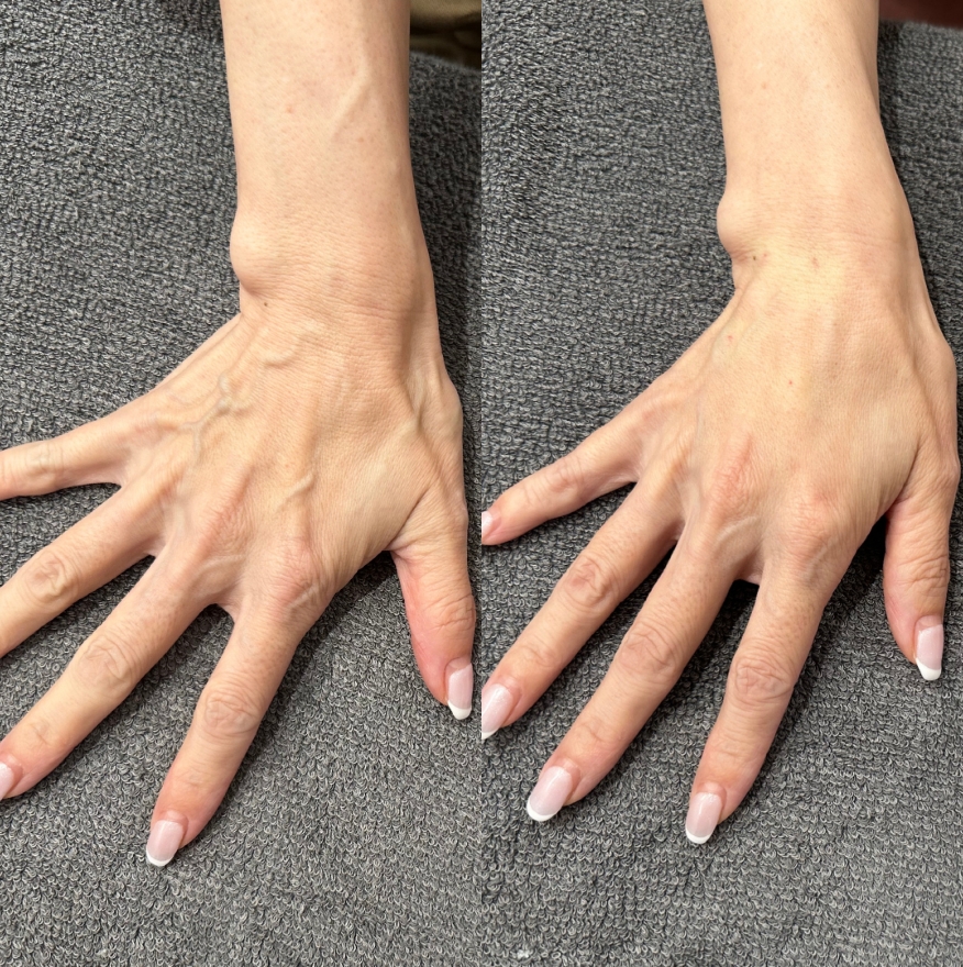 手の甲ヒアルロン酸注射