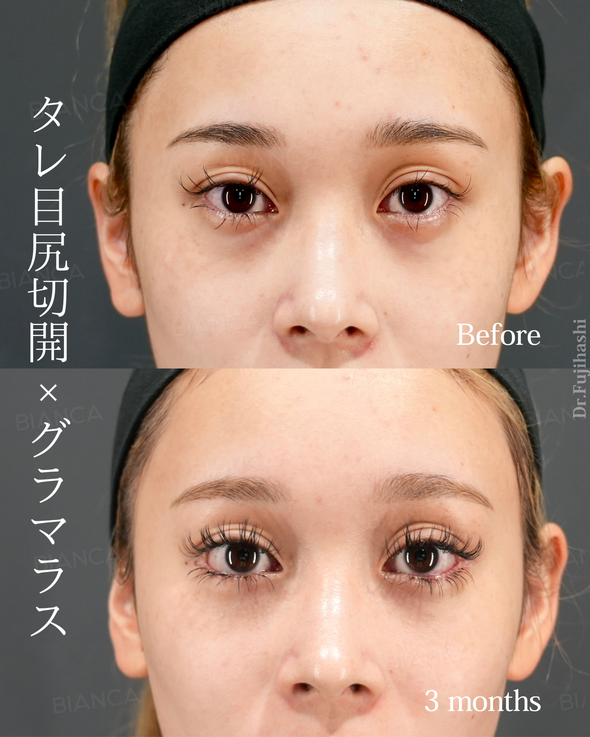 タレ目尻切開 ・グラマラスライン形成