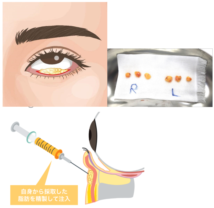 目の下クマ・たるみ取り（経結膜脱脂術）ビアンカ銀座｜日本を代表する美容健康再生医療のクリニック