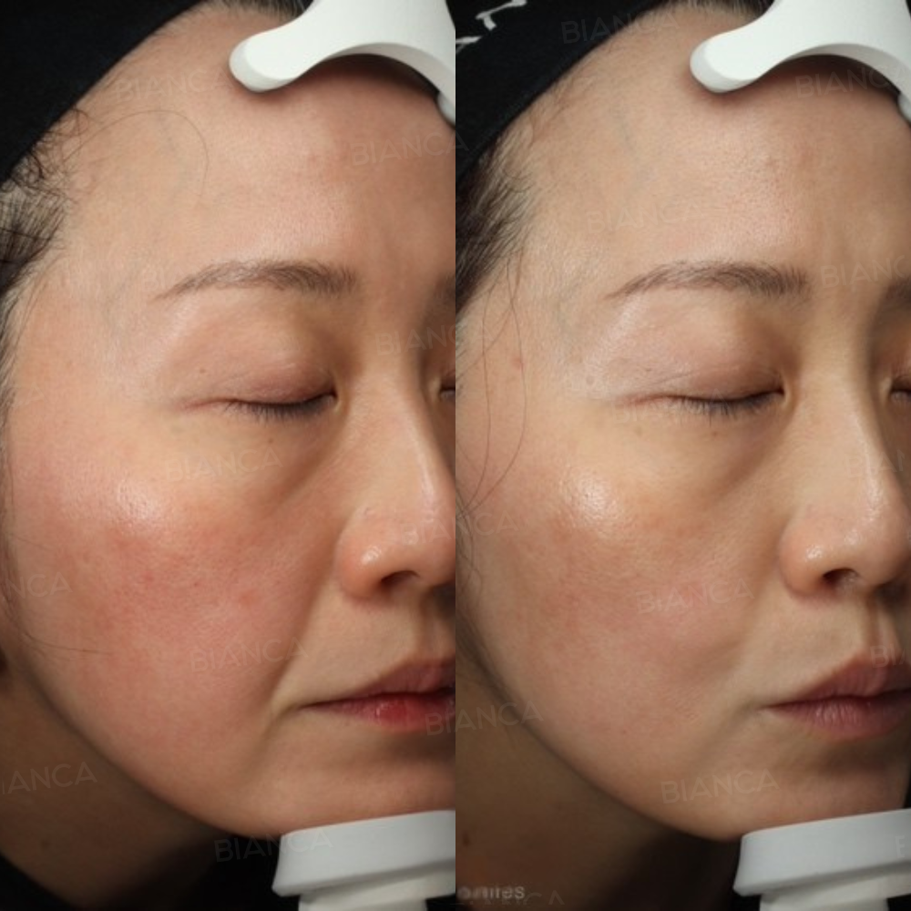 美肌カスタマイズ治療