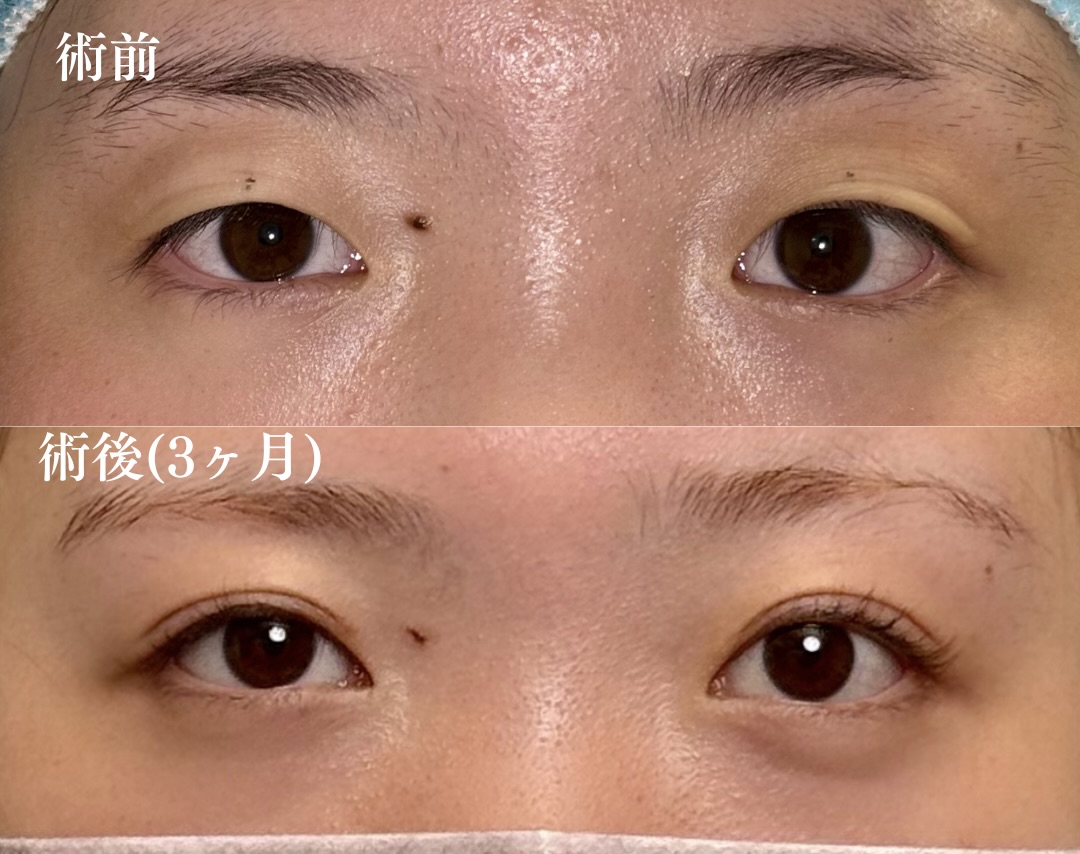 二重切開法 ・目頭切開