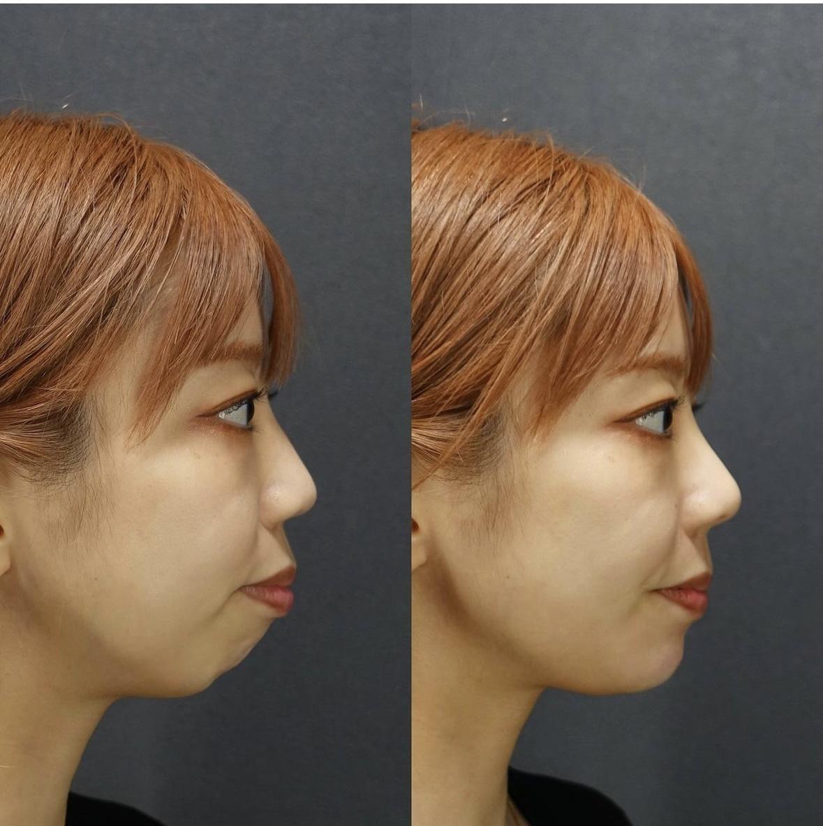 ヒアルロン酸注射