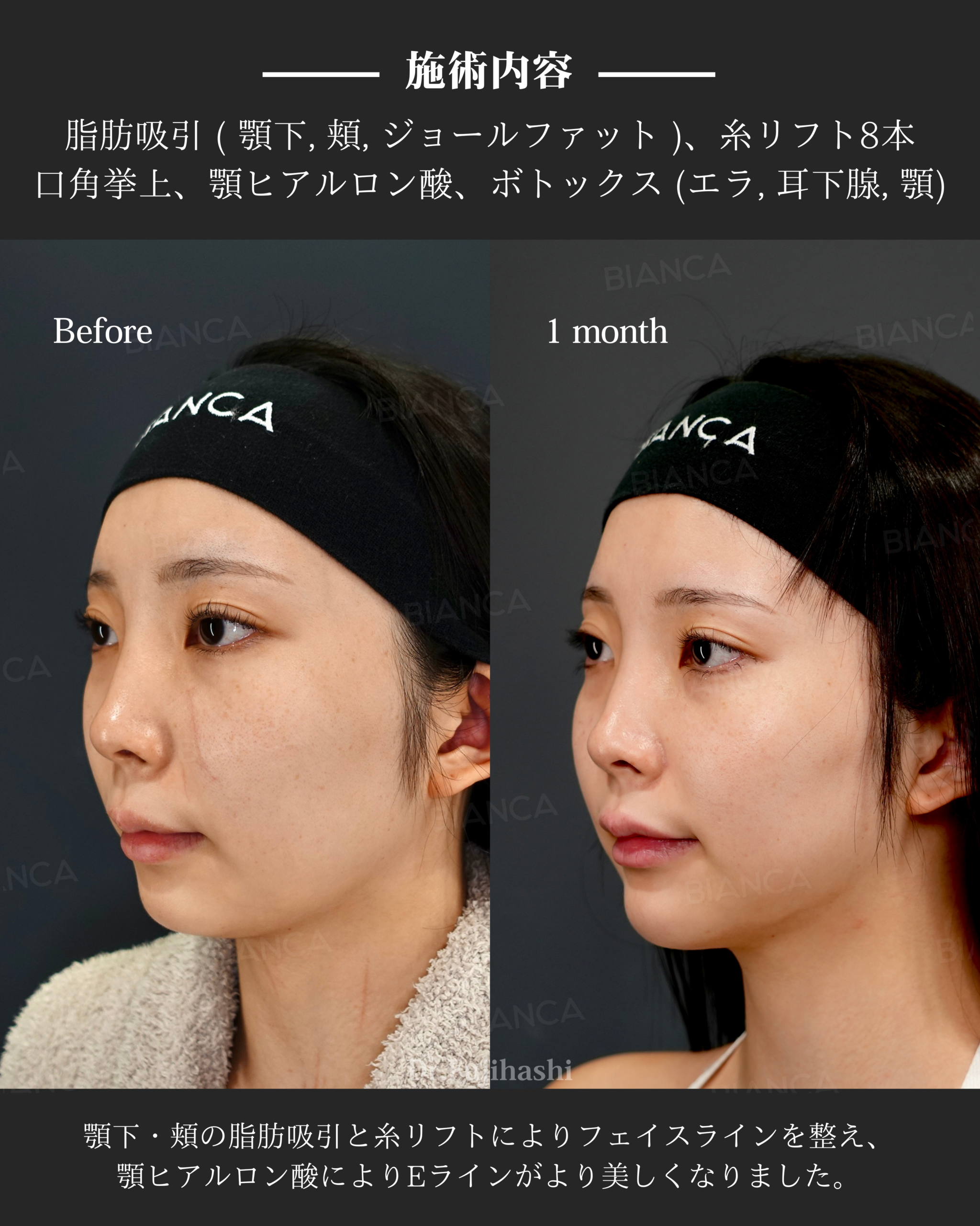 脂肪吸引・糸リフト ・口角挙上 ・ヒアルロン酸注射 ・ボトックス注射