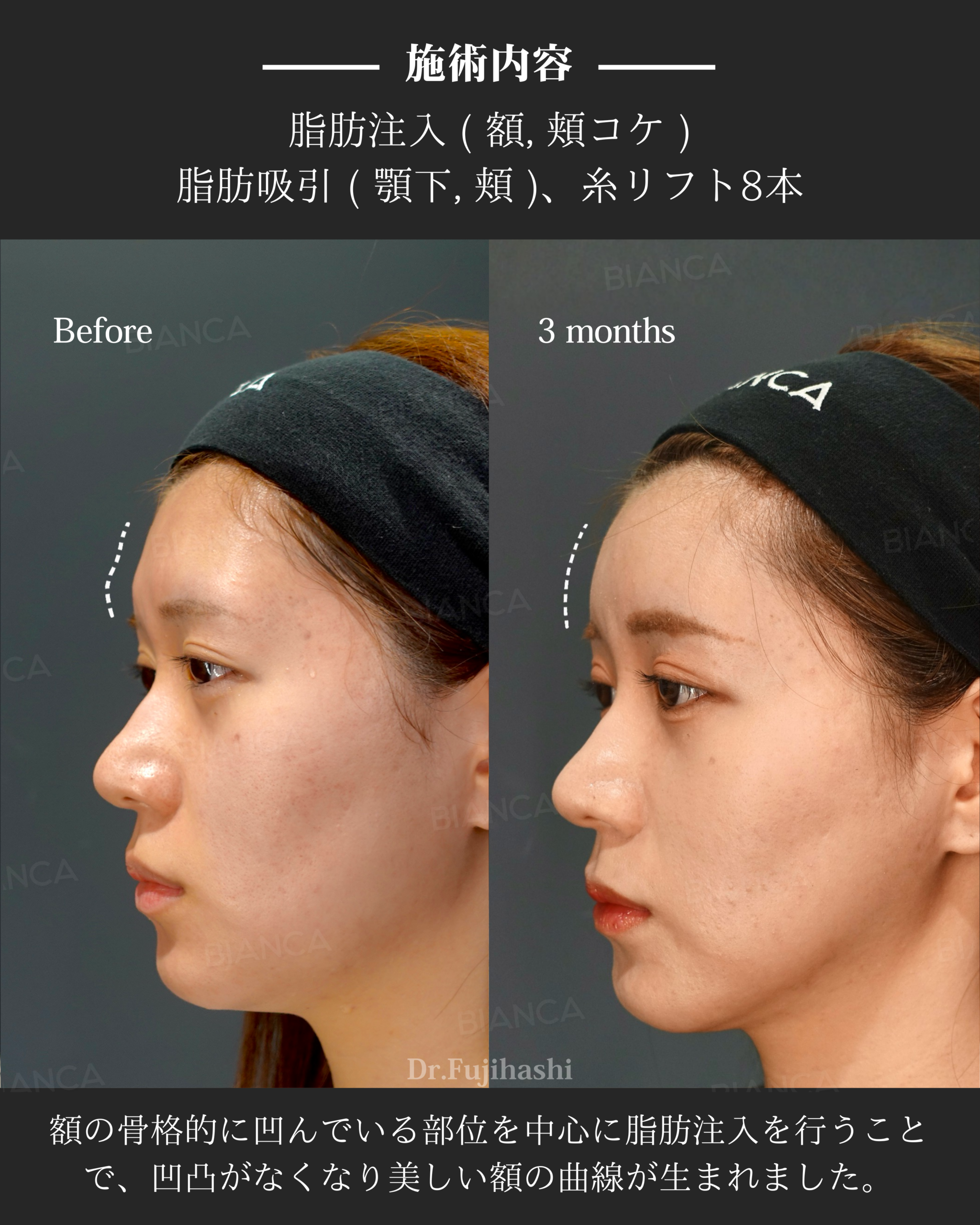 脂肪注入 ・脂肪吸引 ・糸リフト