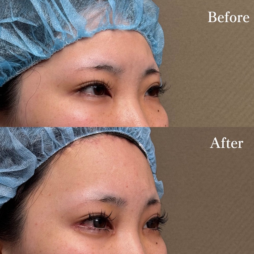 前額リフト ・目頭切開 ・タレ目尻切開