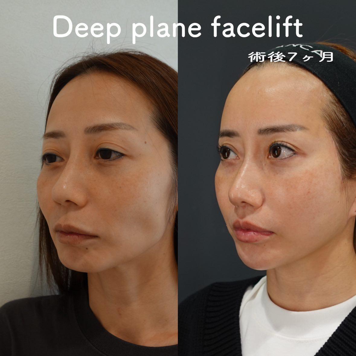 ディーププレーンフェイスリフト