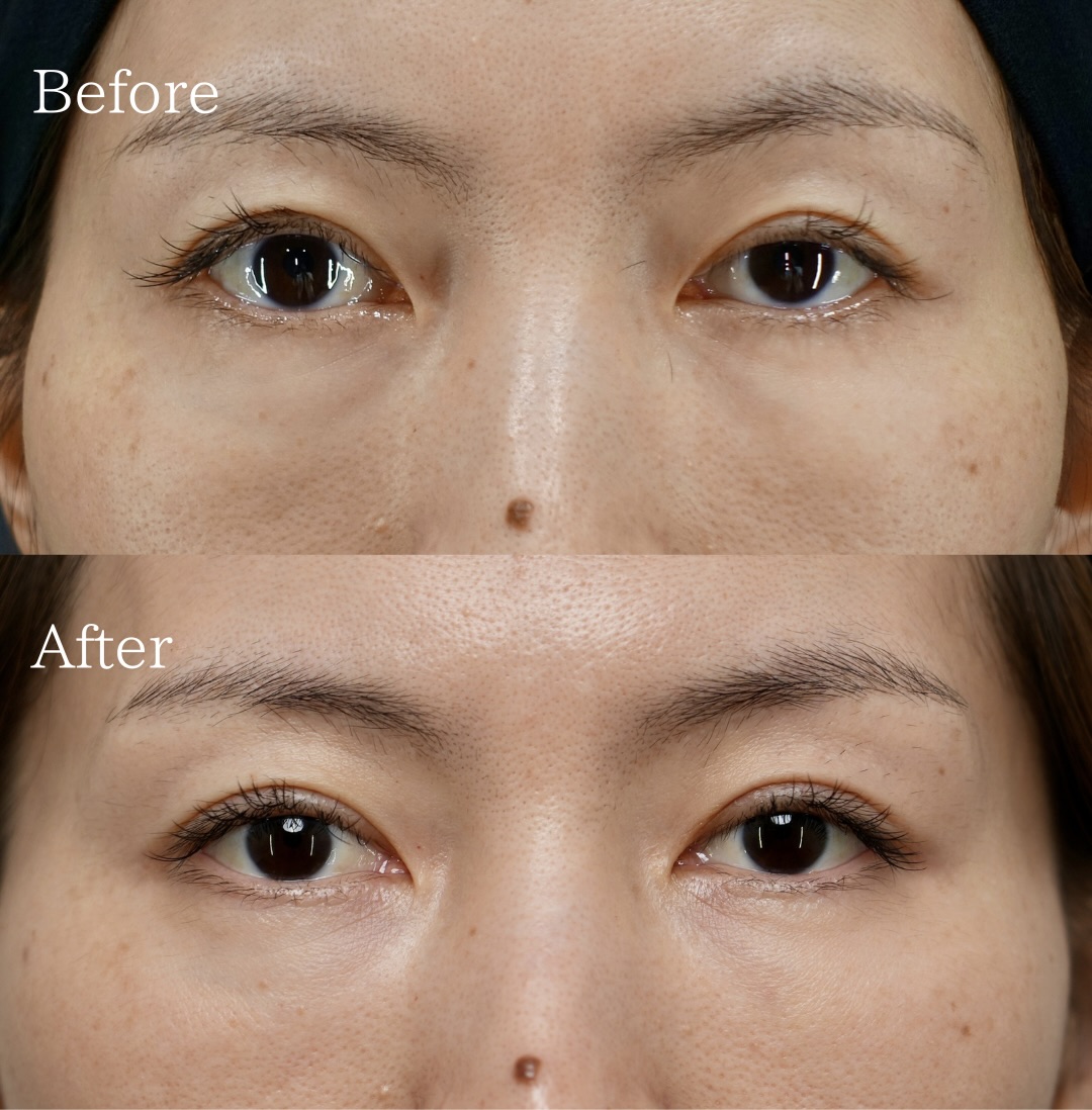 眼瞼下垂切開法