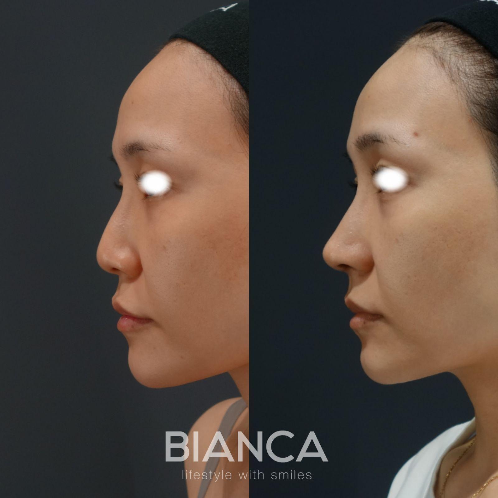 ハンプ切除・鼻中隔延長・鼻尖形成