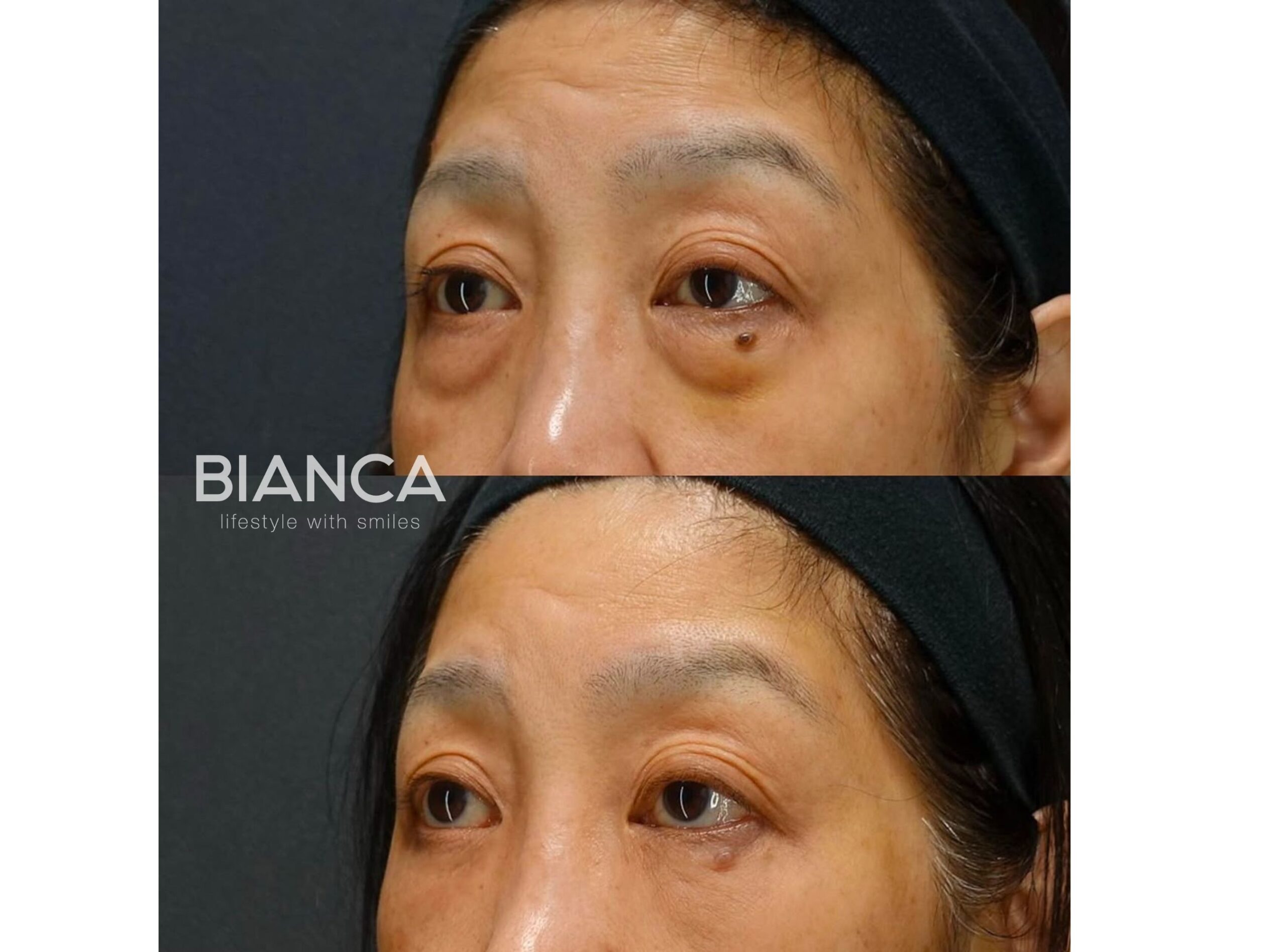 目の下のクマたるみ取り・コンデンスリッチフェイス（CRF）