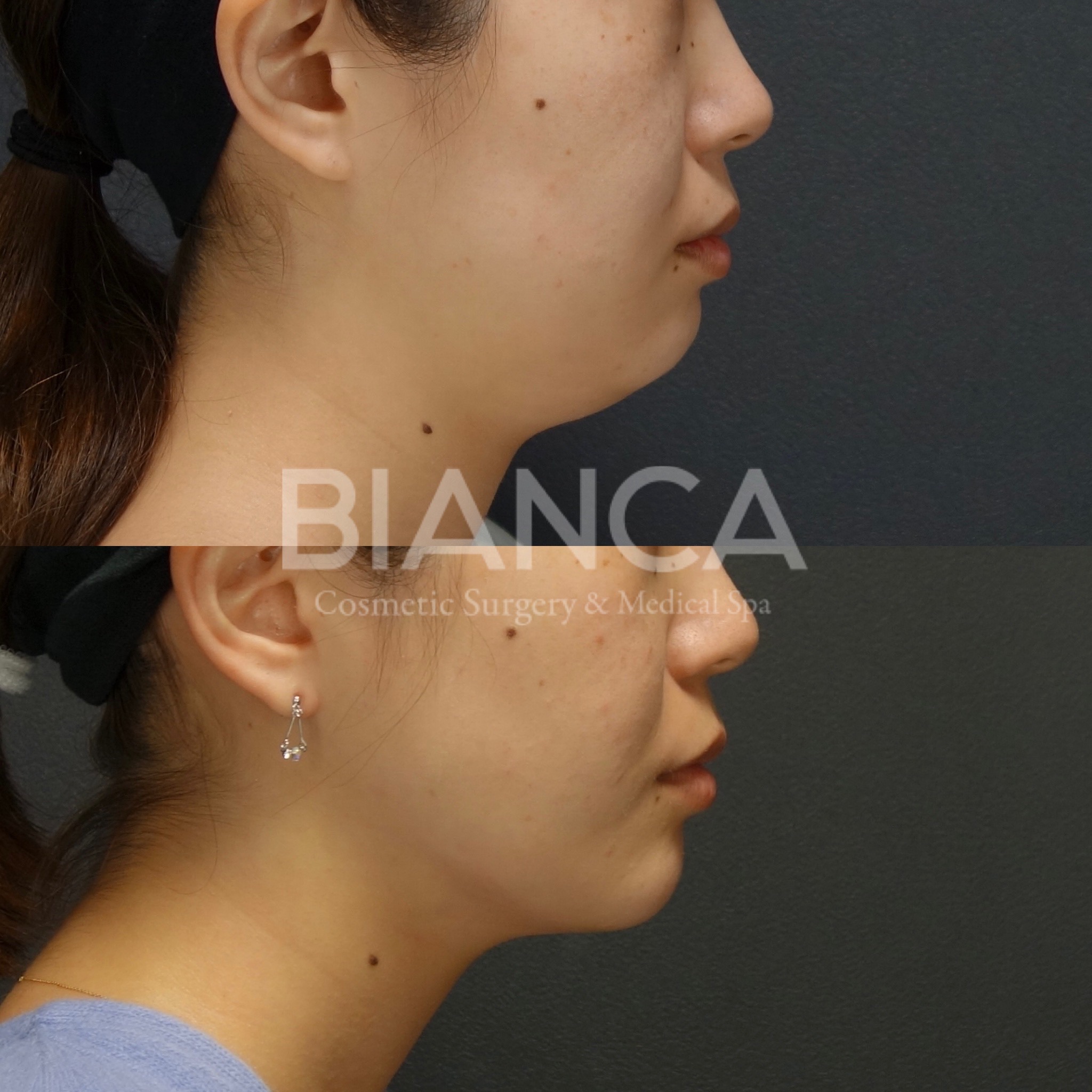 脂肪吸引(フェイスライン 頬＋顎下）