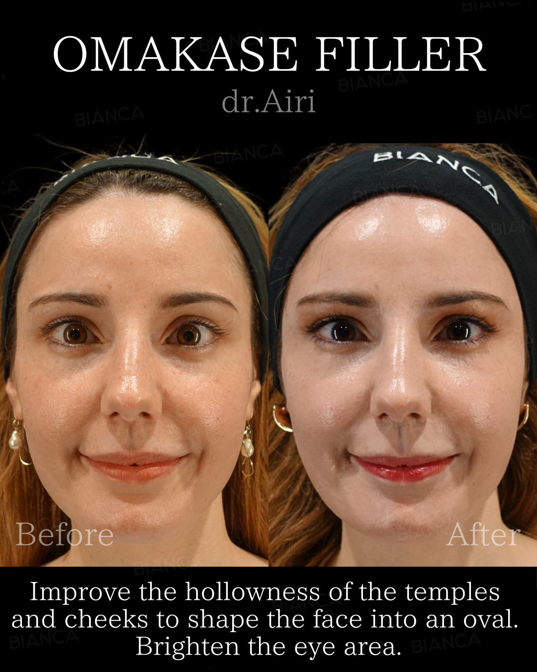 ヒアルロン酸注射・ベビーコラーゲン