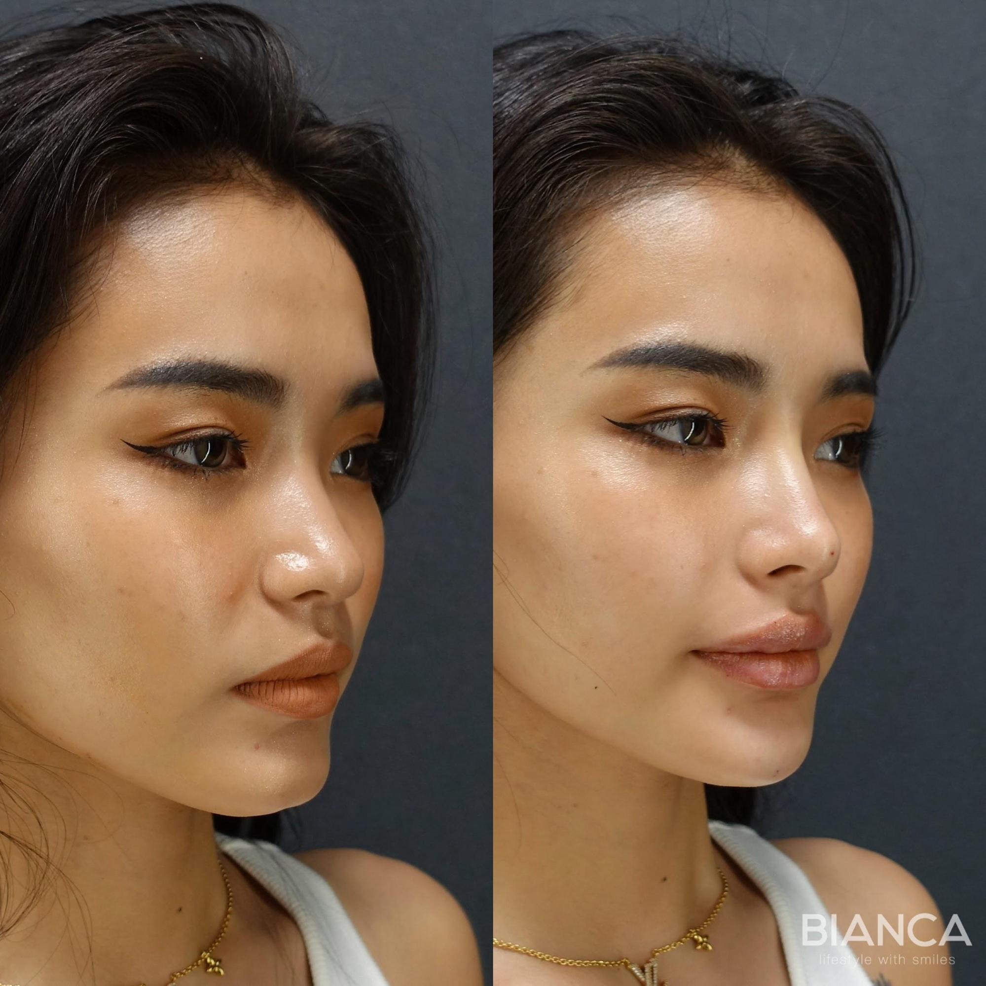 ヒアルロン酸注射