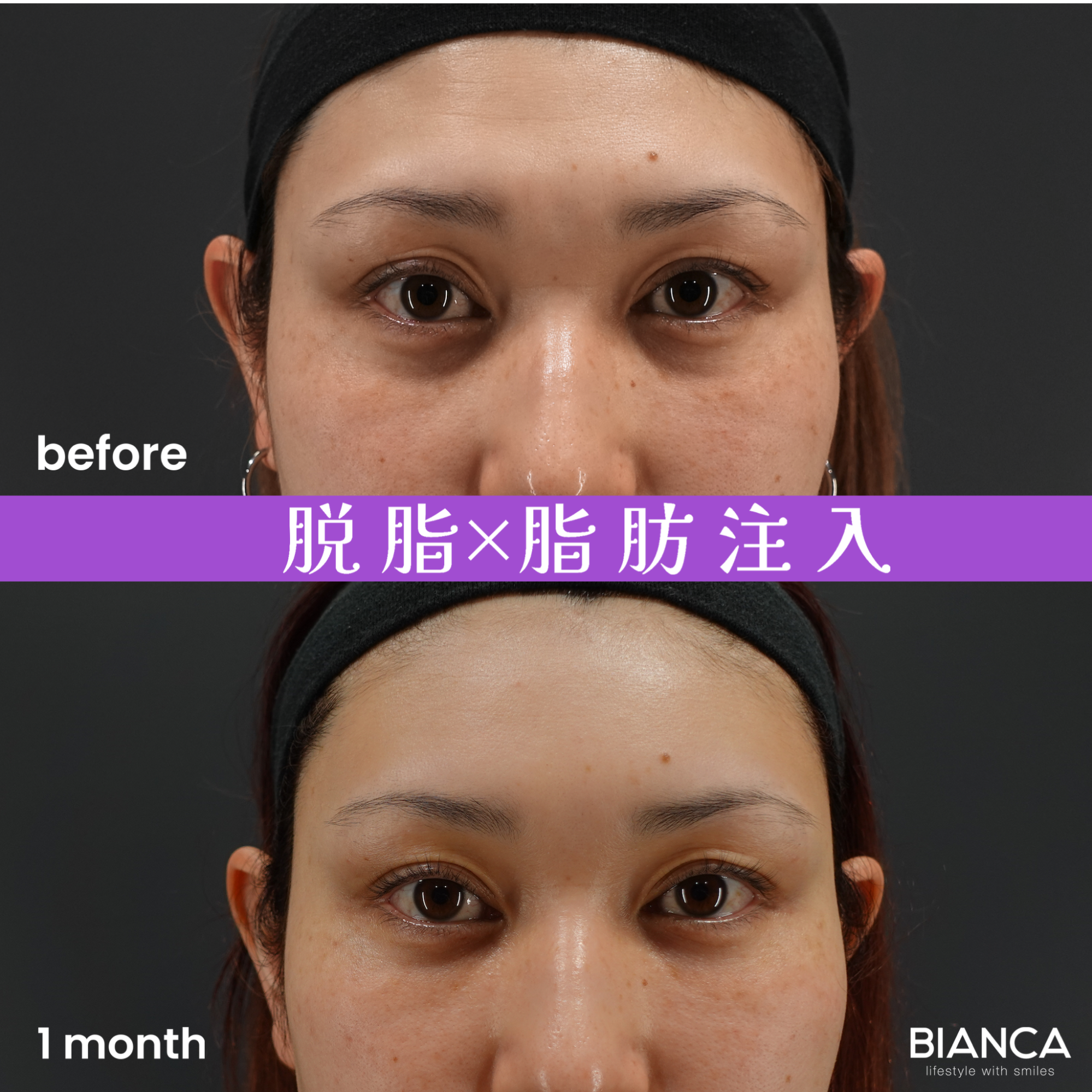 目の下のクマたるみ取り（結膜脱脂術）・脂肪注入