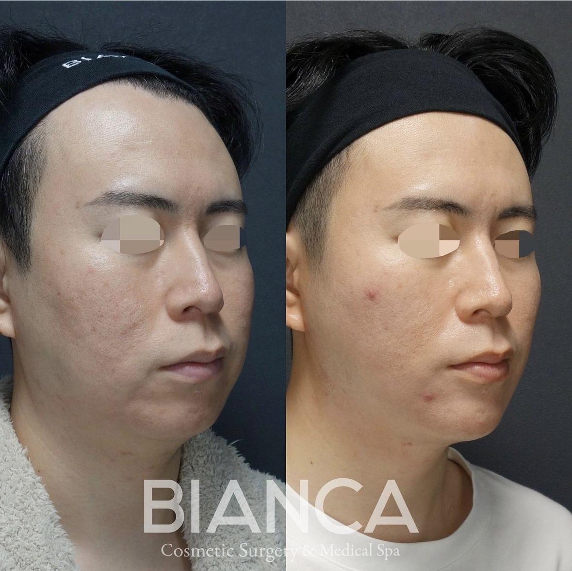 脂肪吸引・バッカルファット除去・メーラーファット除去・糸リフト・ヒアルロン酸注射・ボトックス注射