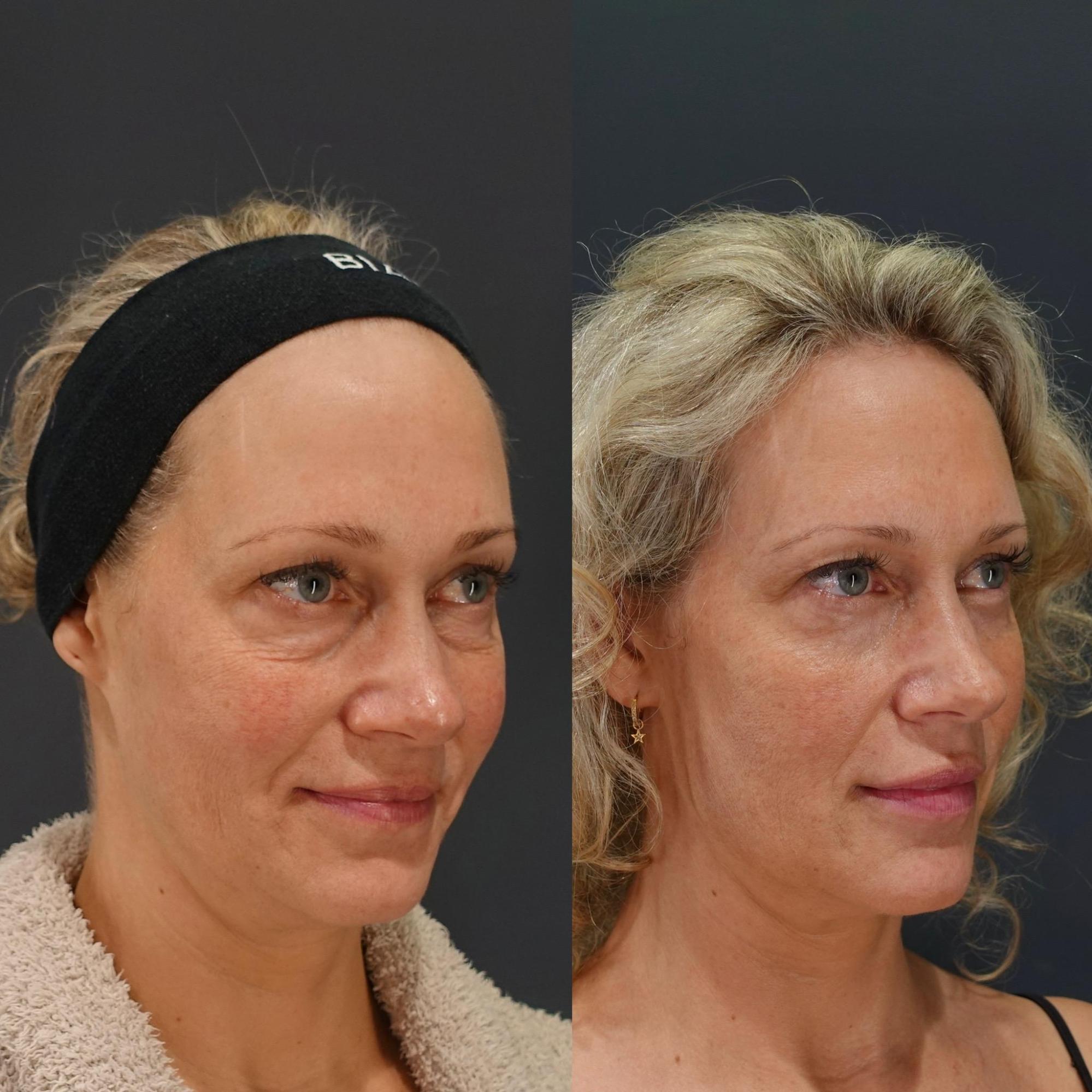 ハムラ法・モフィウス8