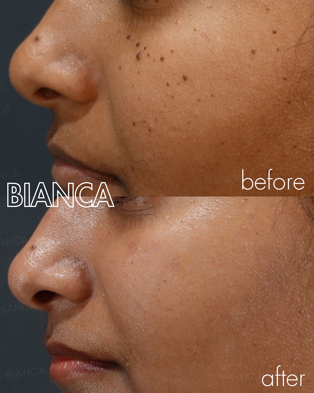 CO2レーザー（ホクロ・イボ取り）