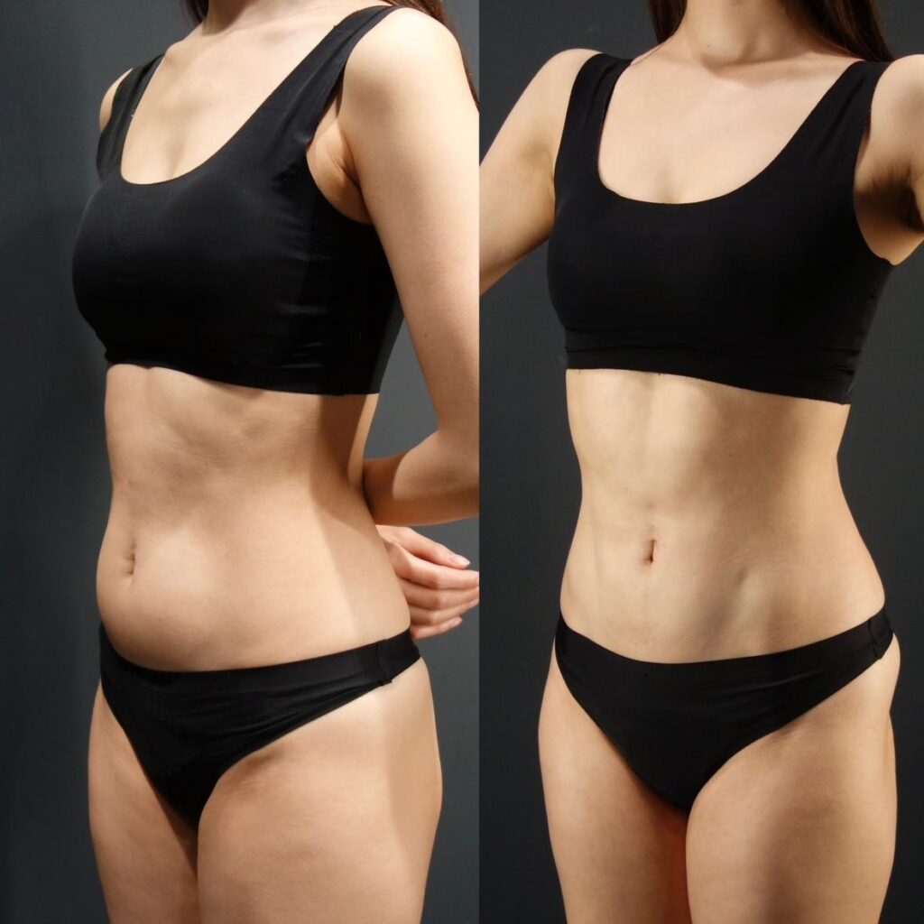 アブクラックス形成