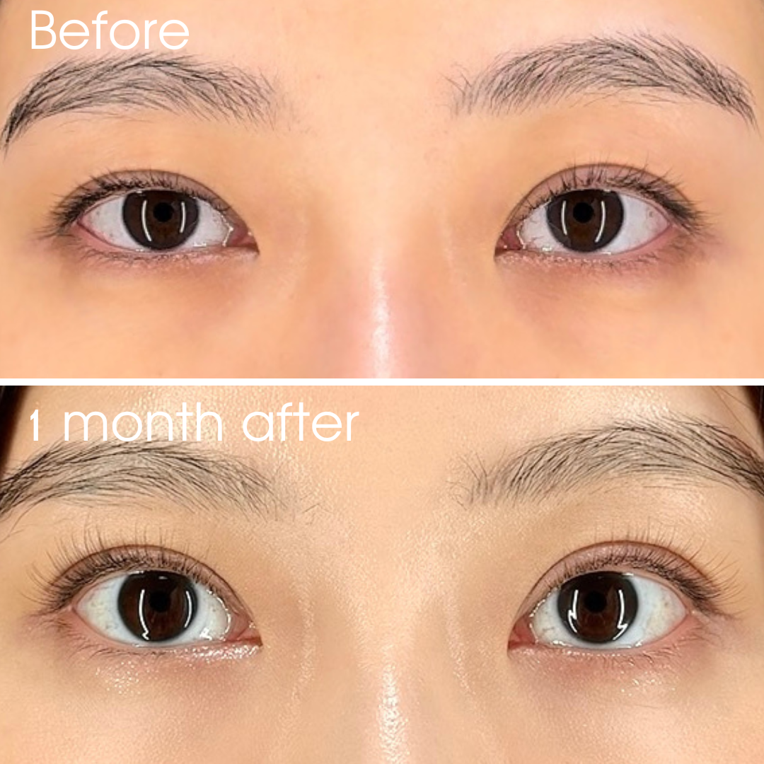 二重埋没法（裏留め）