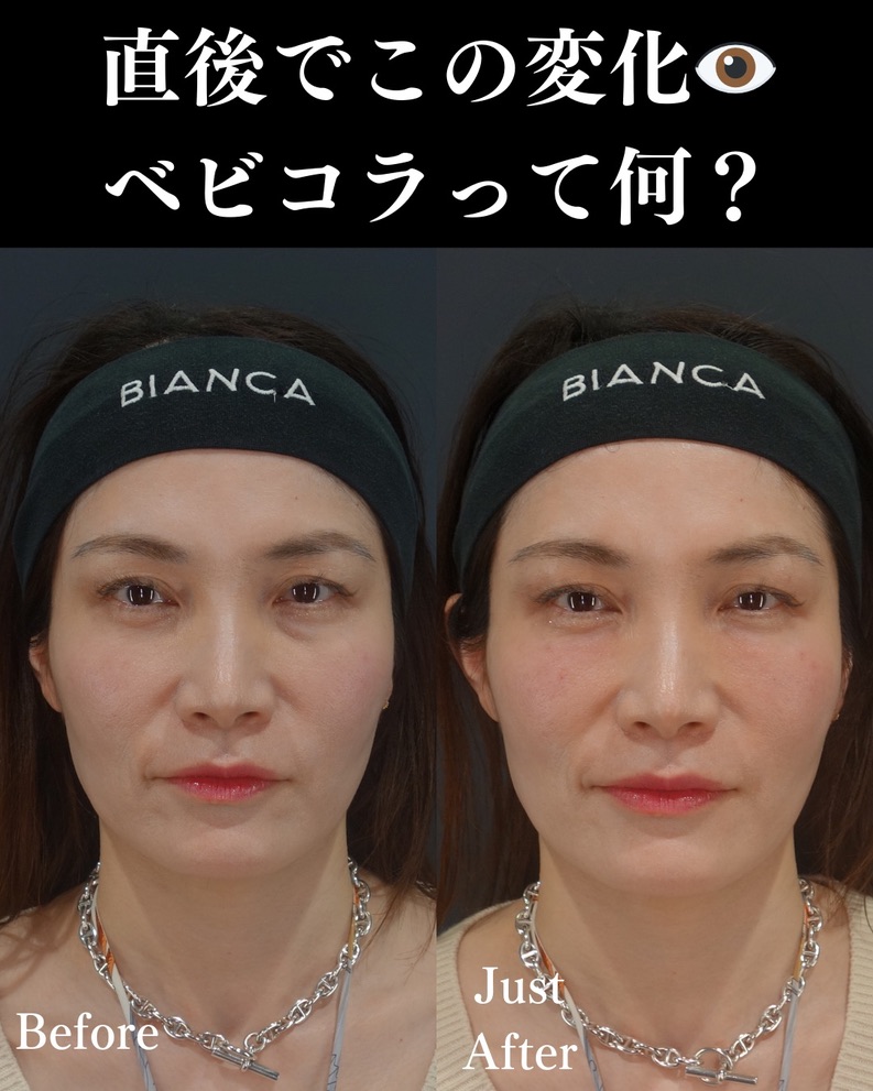 ベビーコラーゲン