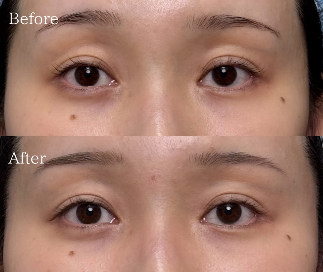 グラマラスライン形成