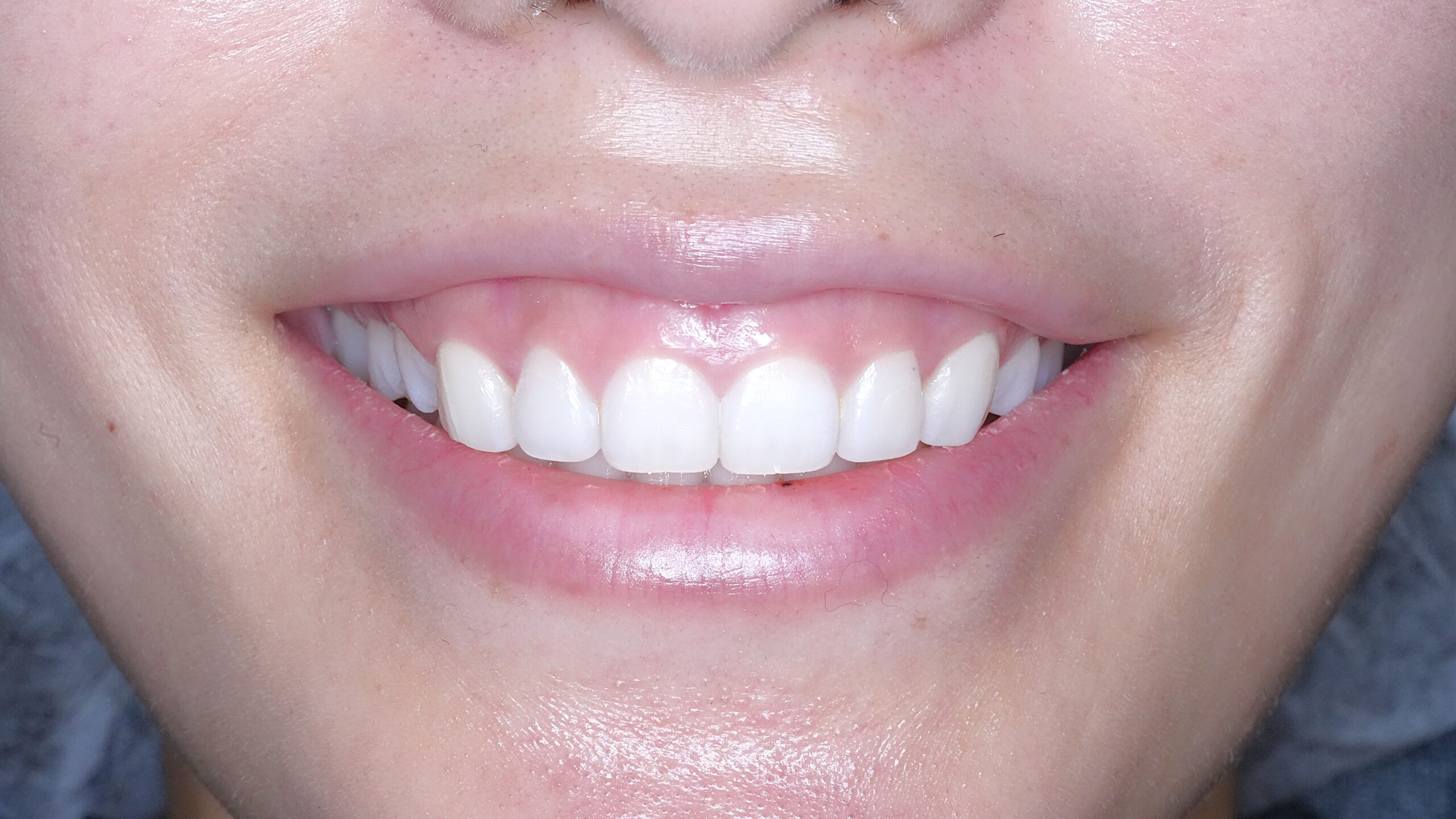 リップリポジショニング（上唇粘膜切除術）