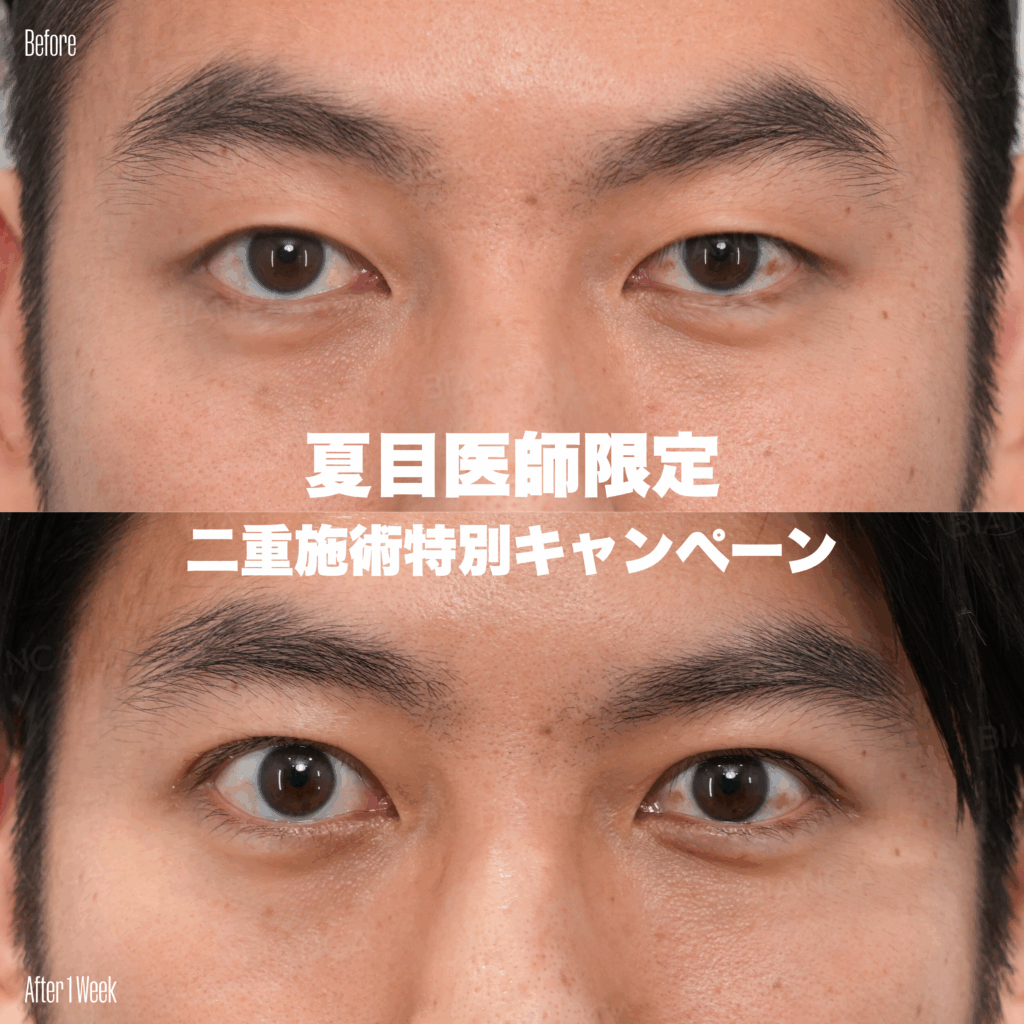 【夏目医師限定】二重半額❣️期間限定モニターキャンペーン