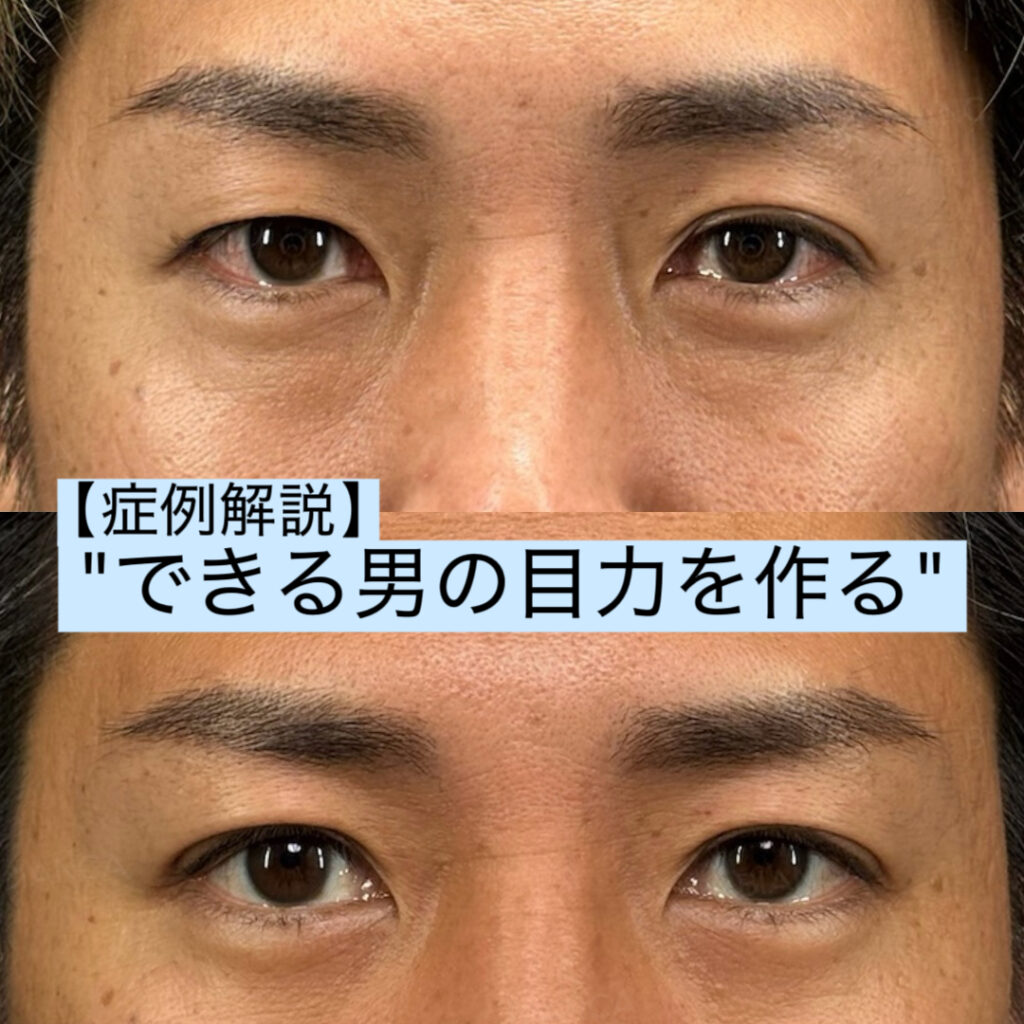 【男性症例】脱脂＋埋没法（自然癒着法）