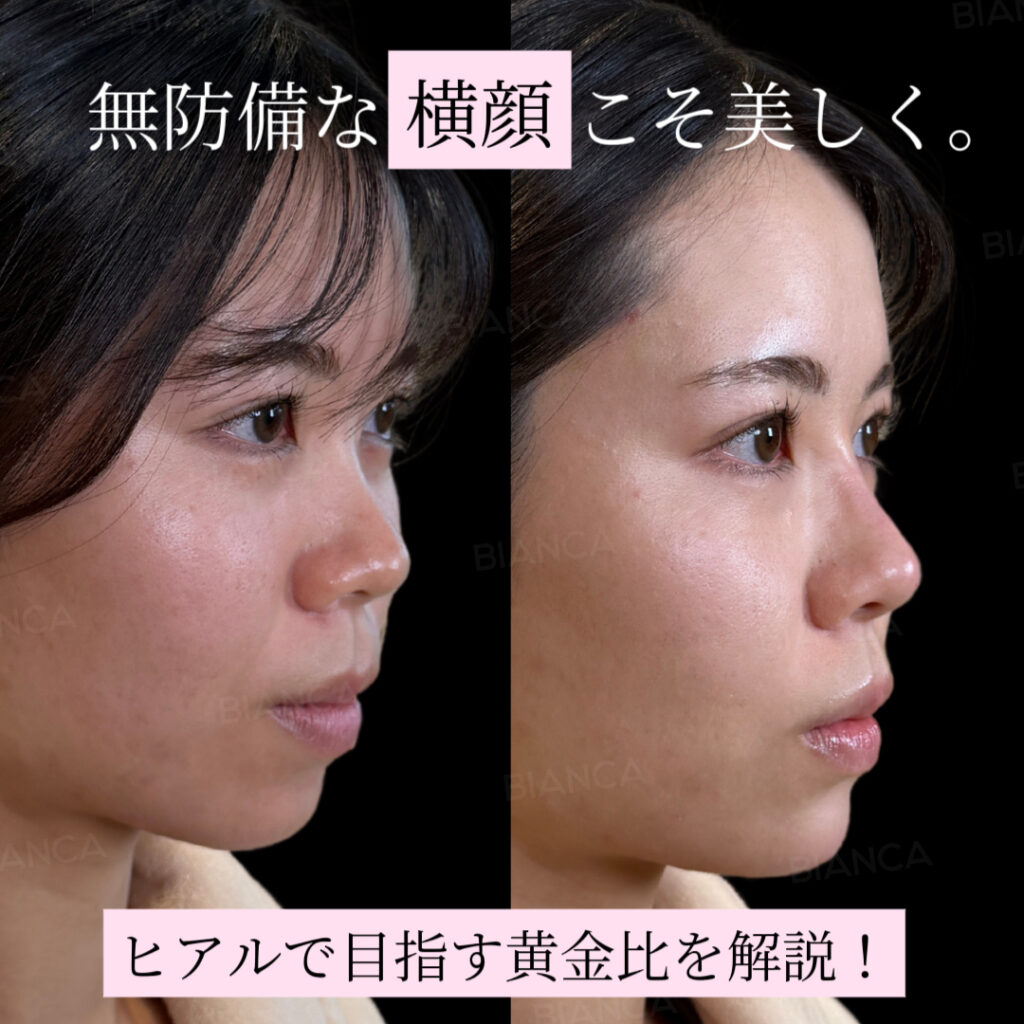 黄金比は不要？その人に合ったヒアルロン酸注入で横顔の美しさを引き出す。